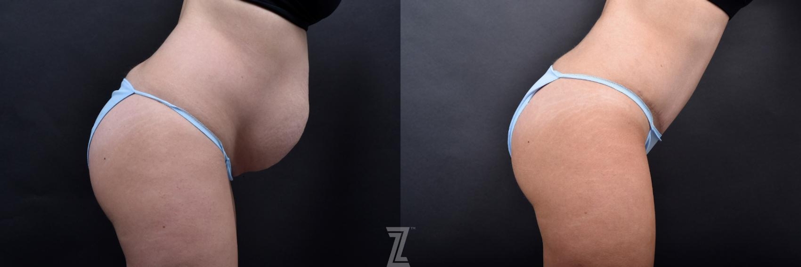 Austin Tummy Tuck Before & After Gallery - Patient 132886800 - Image 5 - The Piazza Center