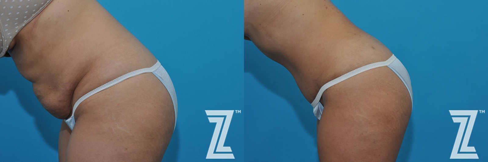 Austin Tummy Tuck Before & After Gallery - Patient 132886863 - Image 4 - The Piazza Center