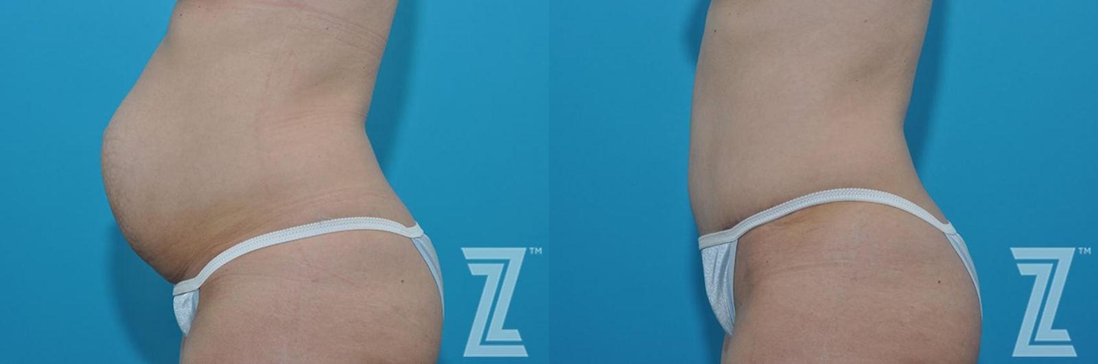 Austin Side abdominal view before & after 3 month post op 39 year old woman mommy make over - The Piazza Center, Austin TX - The Piazza Center
