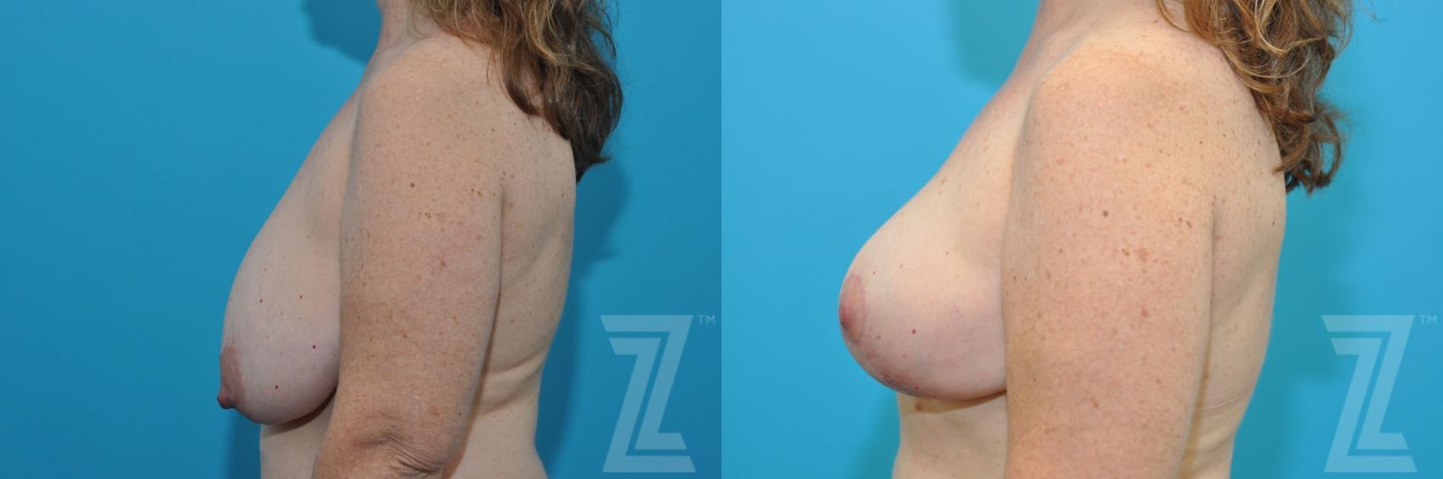 Austin Breast Reduction Before & After Gallery - Patient 132886744 - Image 3 - The Piazza Center