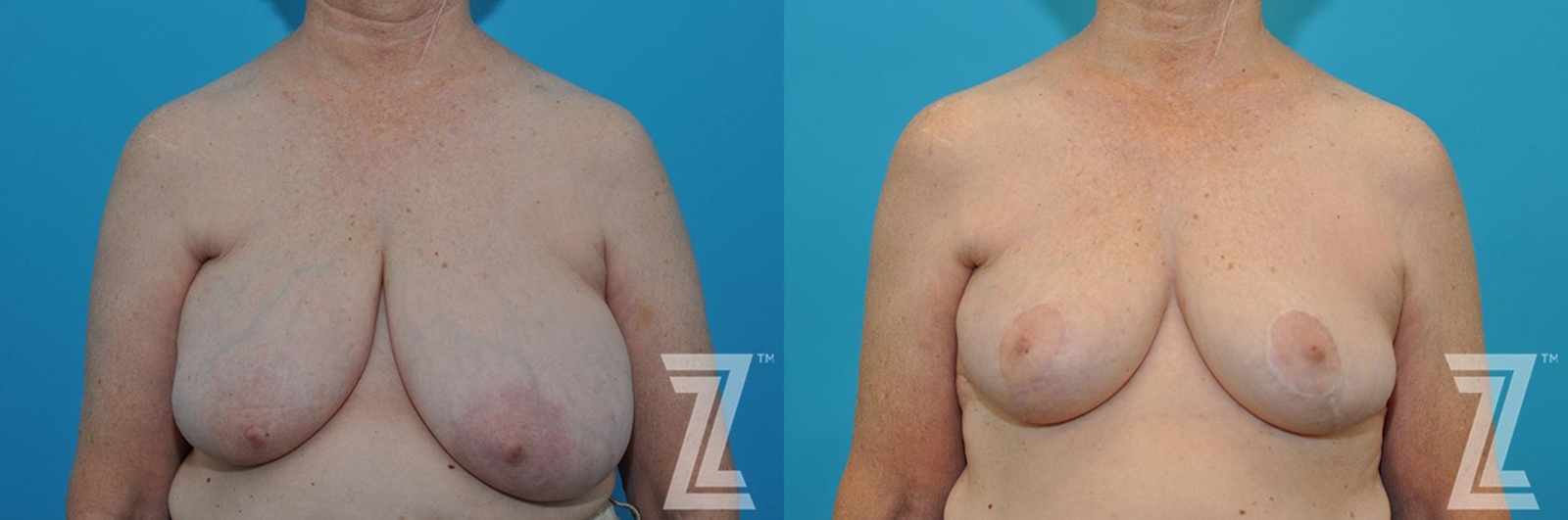 Austin Correction of Breast Asymmetry Before & After Gallery - Patient 132886776 - Image 1 - The Piazza Center