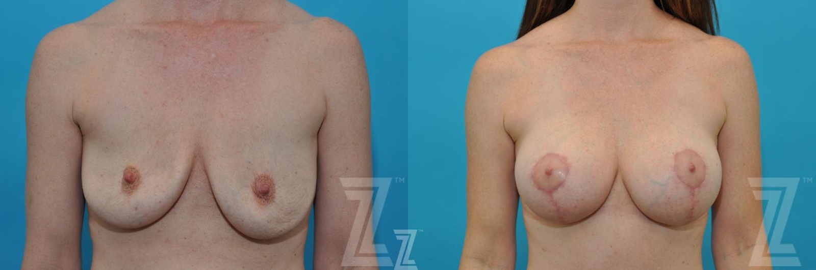 Austin Frontal Breast view before & after images of 35 year old woman mommy make over - Dr. Rocco Piazza Austin TX - The Piazza Center