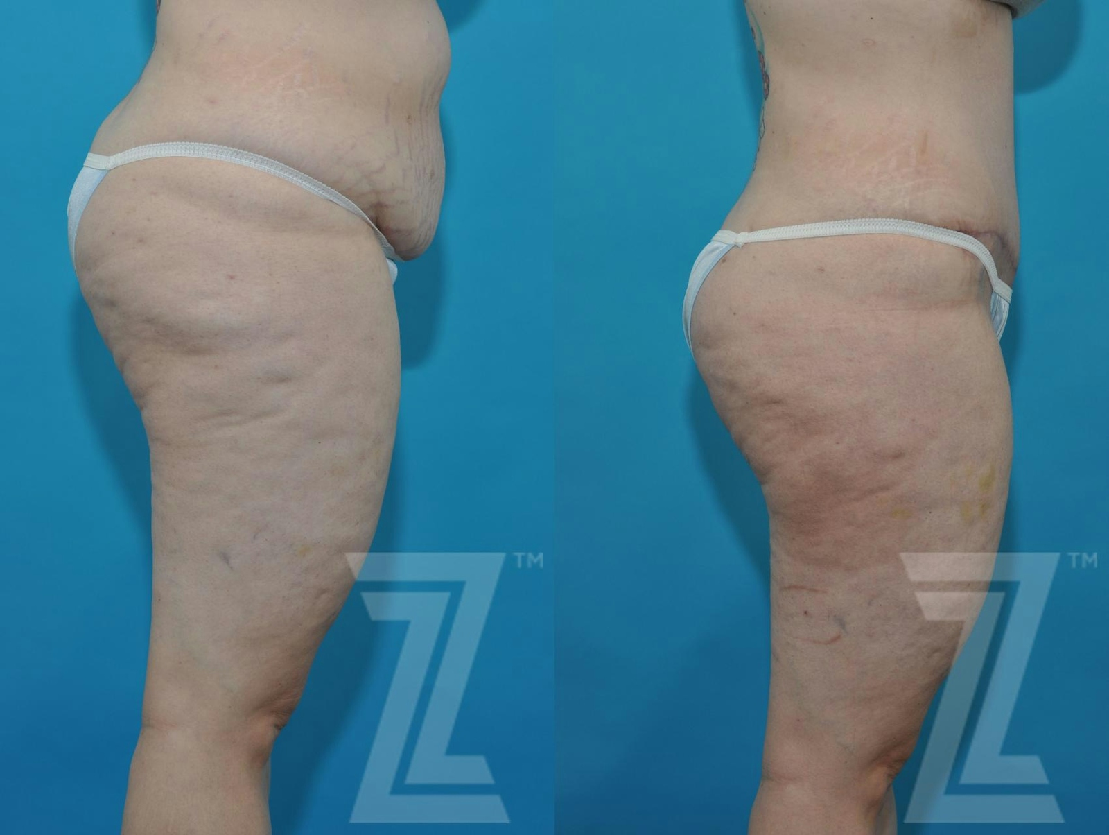 Austin Tummy Tuck Before & After Gallery - Patient 132886824 - Image 10 - The Piazza Center
