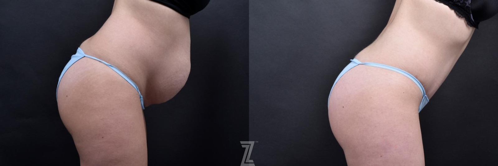 Austin Tummy Tuck Before & After Gallery - Patient 132886793 - Image 5 - The Piazza Center