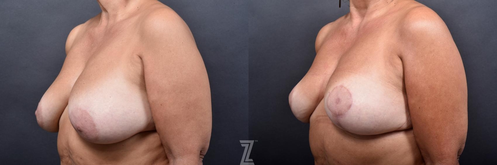 Austin Breast Lift Before & After Gallery - Patient 132791067 - Image 2 - The Piazza Center