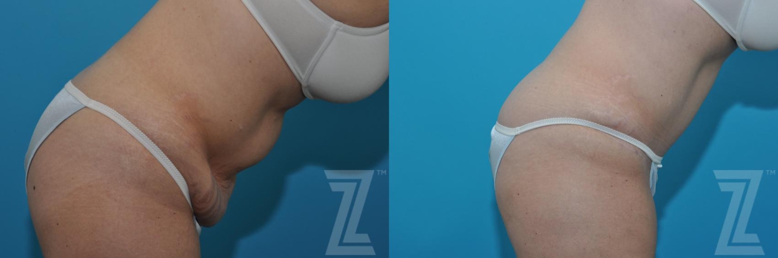 Austin Tummy Tuck Before & After Gallery - Patient 132886869 - Image 5 - The Piazza Center