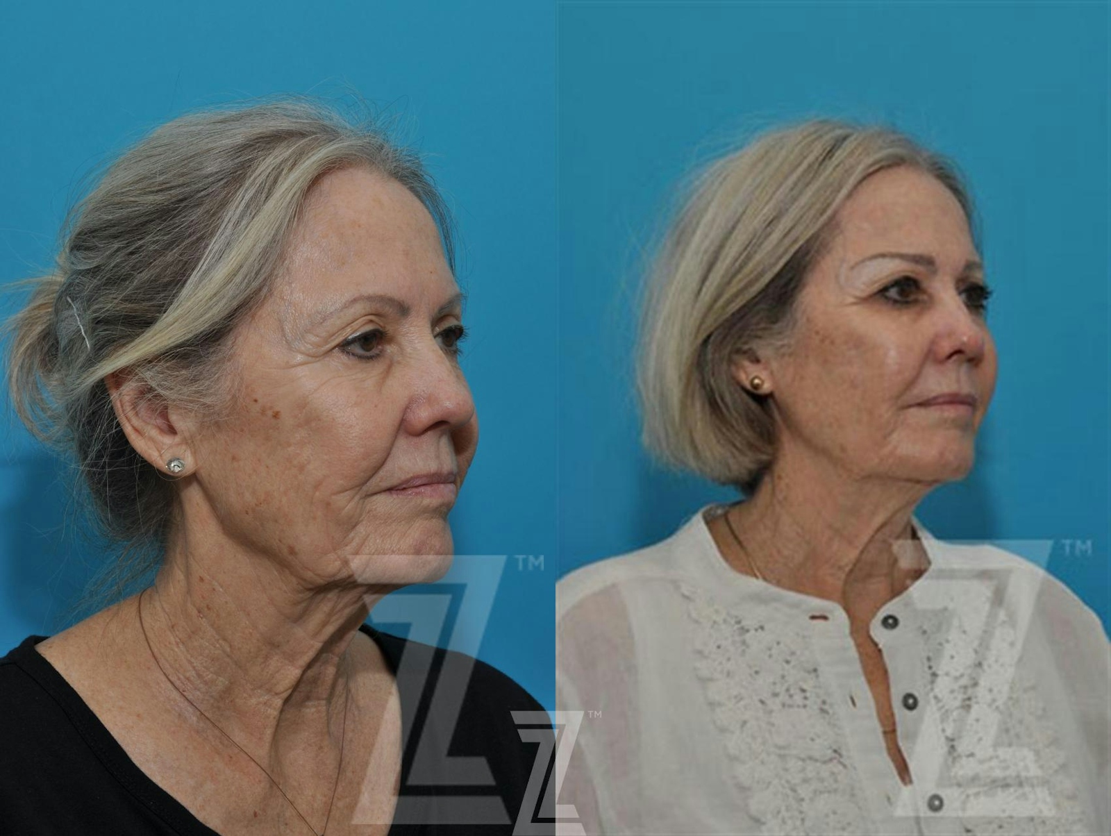 Austin Sculptra® Before & After Gallery - Patient 132963132 - Image 4 - The Piazza Center
