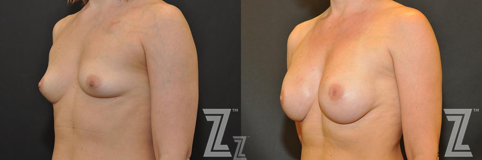Austin Breast Reconstruction Before & After Gallery - Patient 132886763 - Image 2 - The Piazza Center