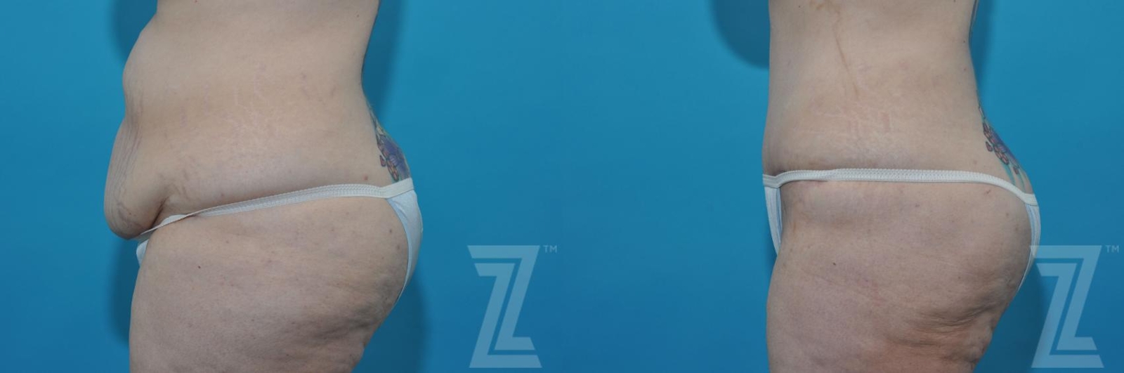 Austin Tummy Tuck Before & After Gallery - Patient 132886824 - Image 2 - The Piazza Center