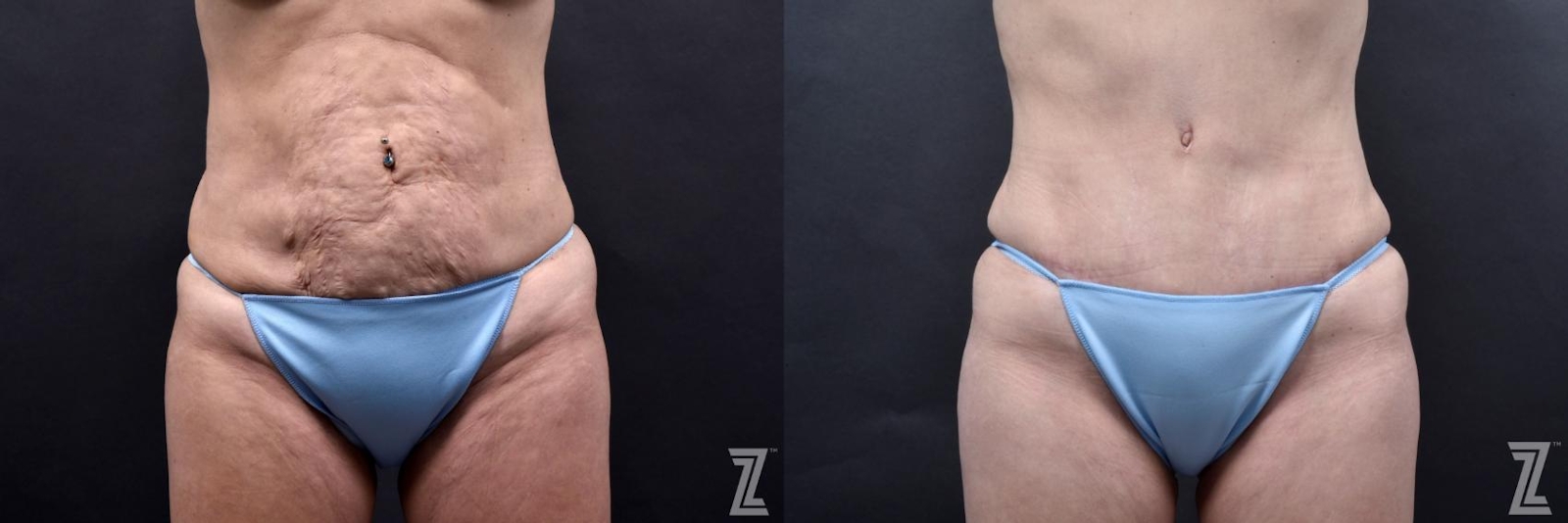 Austin Tummy Tuck Before & After Gallery - Patient 132886812 - Image 1 - The Piazza Center