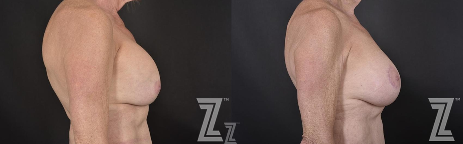 Austin Breast Reconstruction Before & After Gallery - Patient 132886765 - Image 5 - The Piazza Center