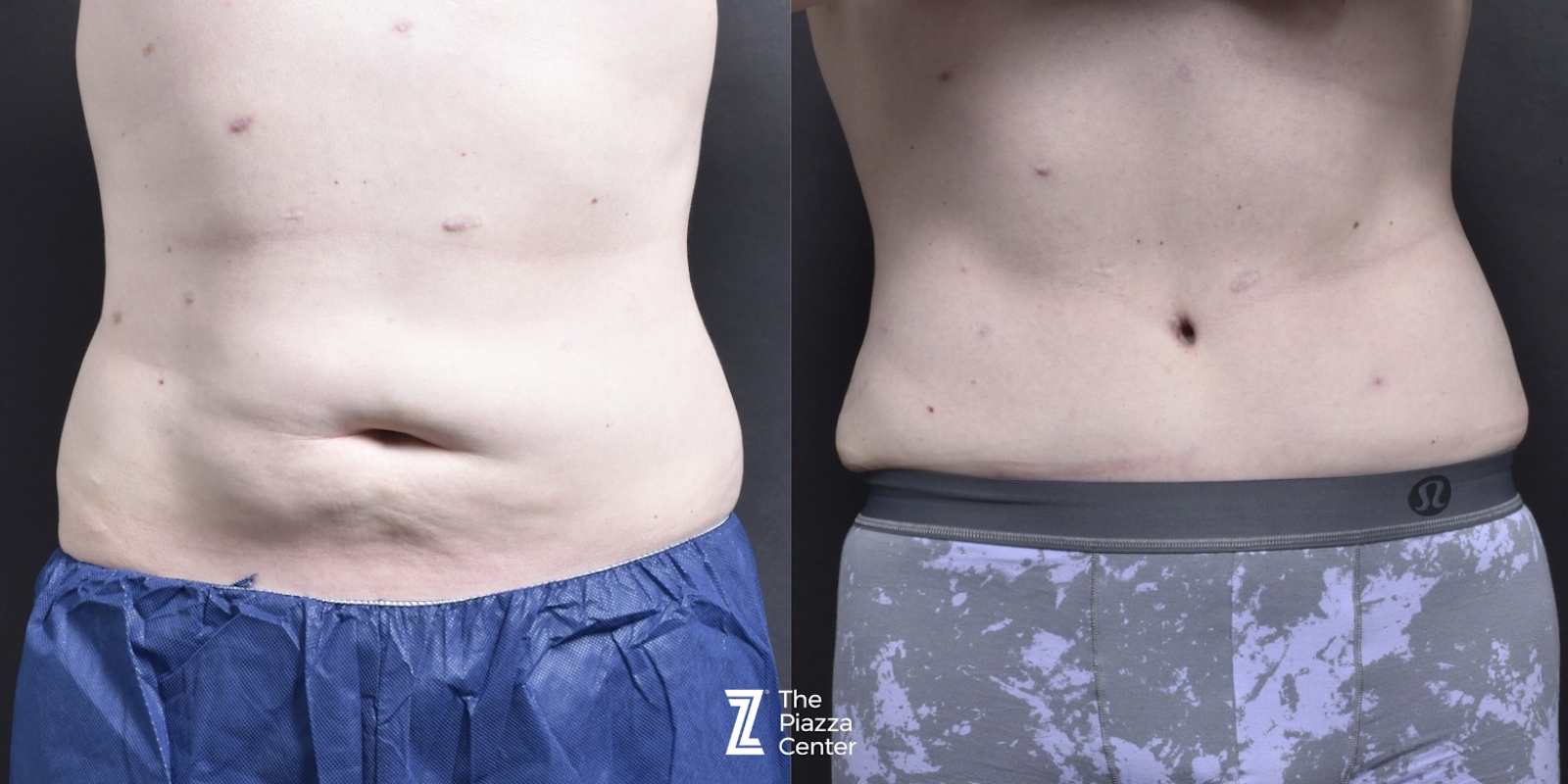 Austin Male Body Contouring Before & After Gallery - Patient 352011 - Image 1 - The Piazza Center