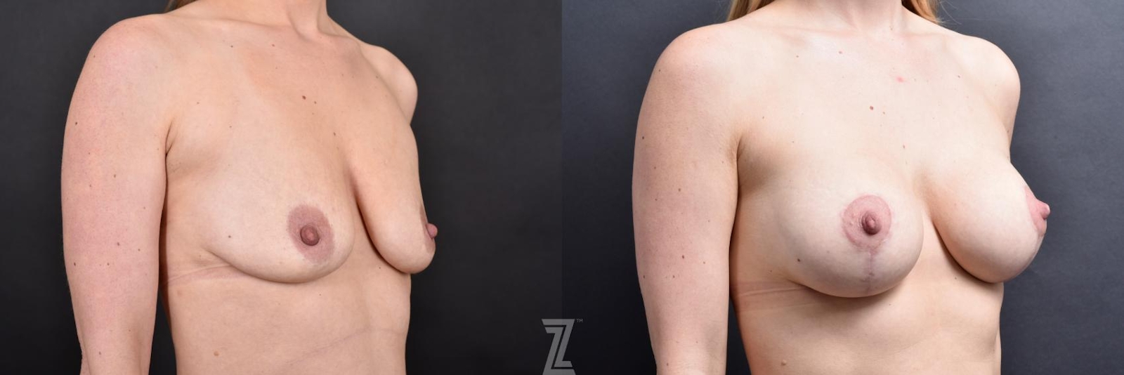 Austin Breast Augmentation With a Breast Lift Before & After Gallery - Patient 132791129 - Image 4 - The Piazza Center
