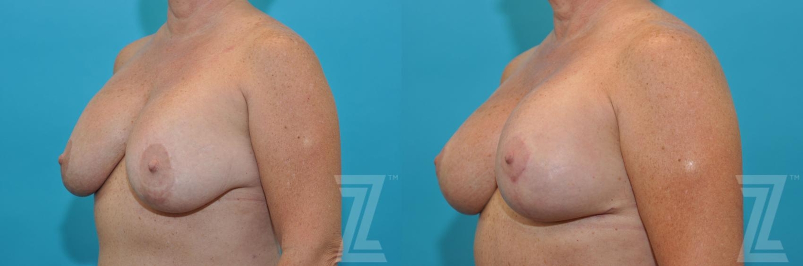 Austin Breast Augmentation Revision Before & After Gallery - Patient 132886540 - Image 2 - The Piazza Center