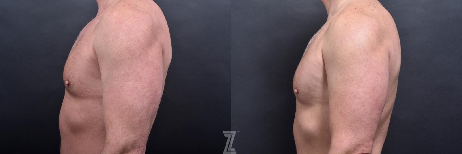 Austin Male Body Contouring Before & After Gallery - Patient 173307 - Image 5 - The Piazza Center