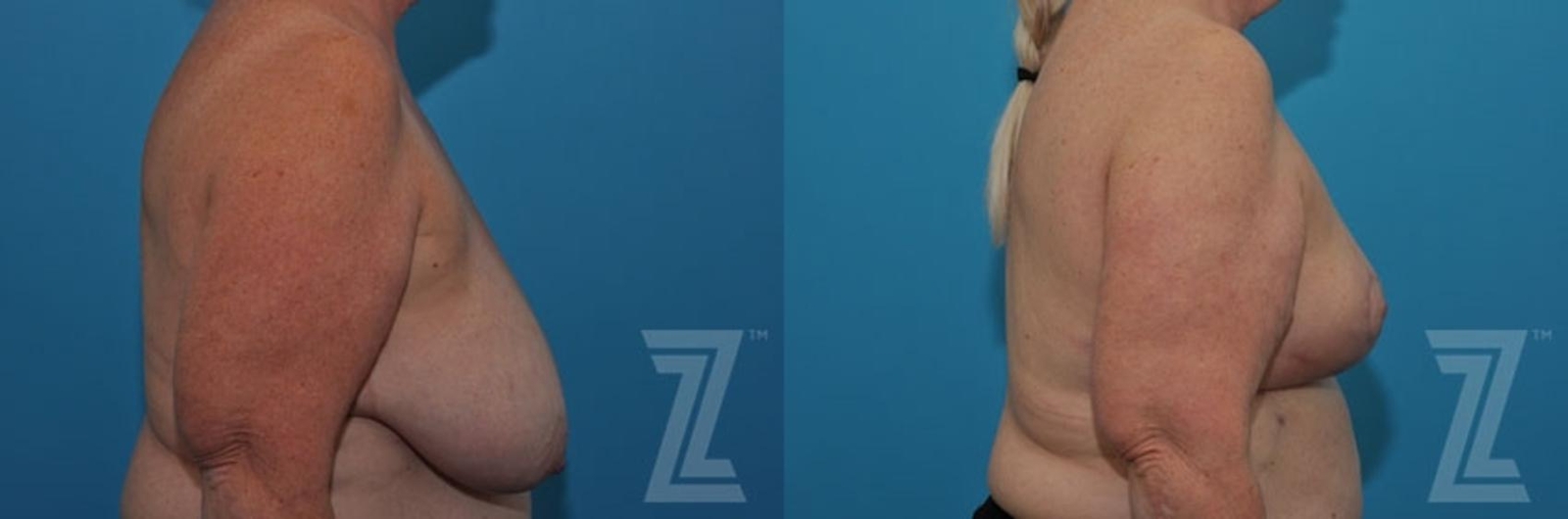 Austin Breast Reduction Before & After Gallery - Patient 132886611 - Image 5 - The Piazza Center