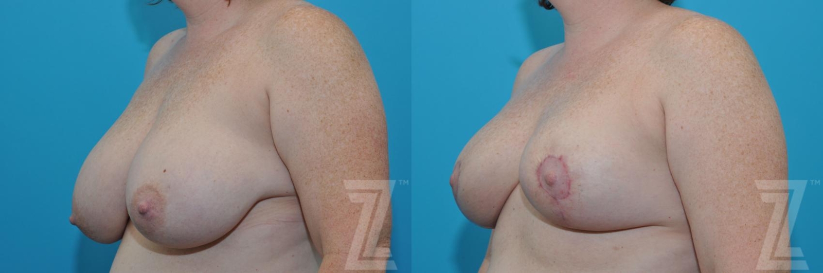 Austin Breast Reduction Before & After Gallery - Patient 132886606 - Image 2 - The Piazza Center