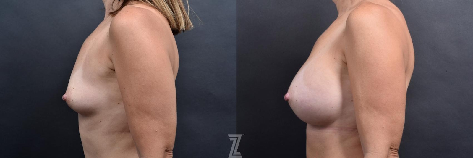 Austin side before and after images of 39 year old woman with Silicone Implants with Cohesive Silicone Gel - The Piazza Center - The Piazza Center