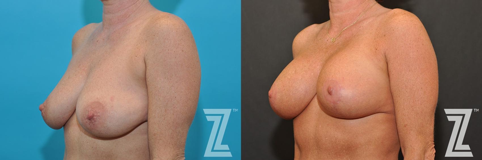 Austin Breast Augmentation With a Breast Lift Before & After Gallery - Patient 132791107 - Image 2 - The Piazza Center