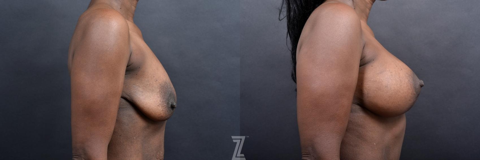 Austin 1 Year Post-OP Mommy Makeover in Austin, TX by Dr. Rocco Piazza - Lateral View of Breasts - The Piazza Center