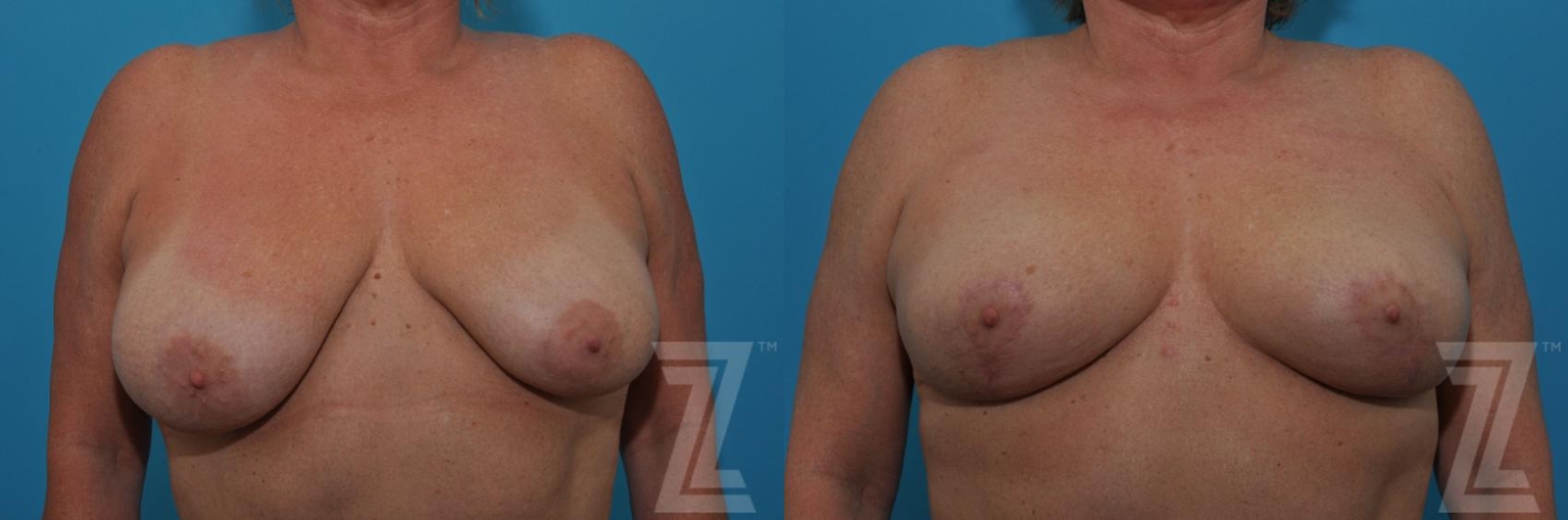 Austin Breast Lift Before & After Gallery - Patient 132791080 - Image 1 - The Piazza Center