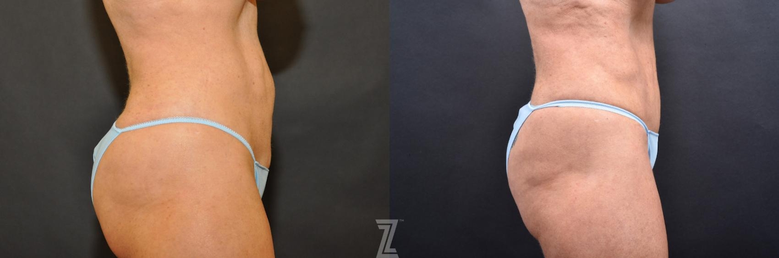 Austin Skin Pinch Before & After Gallery - Patient 132886906 - Image 4 - The Piazza Center