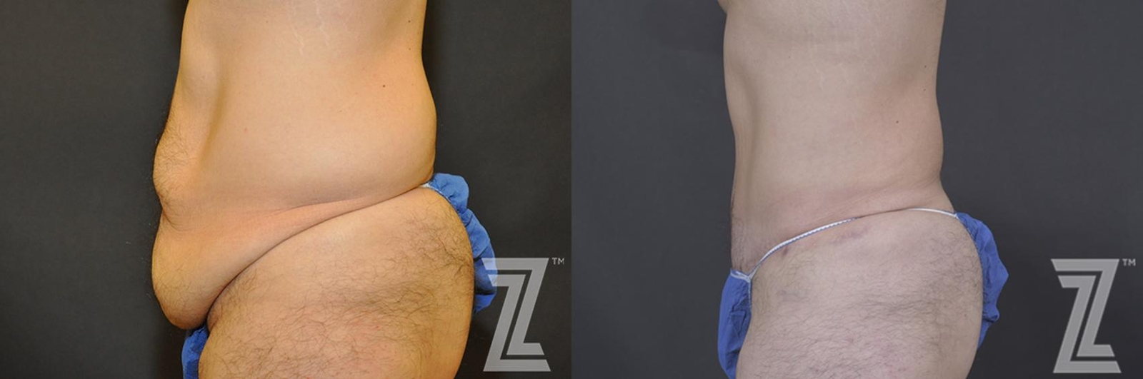 Austin Male Body Contouring Before & After Gallery - Patient 183281 - Image 2 - The Piazza Center