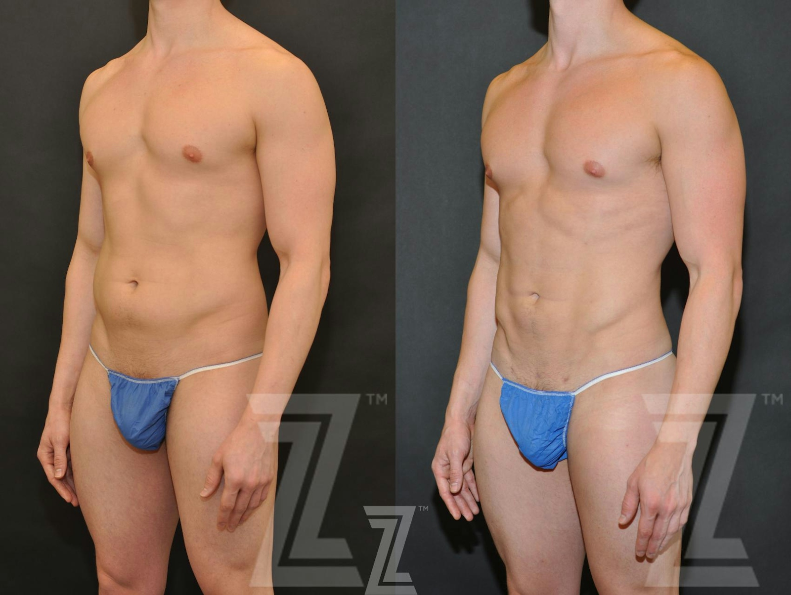 Austin Male Body Contouring Before & After Gallery - Patient 174118 - Image 2 - The Piazza Center