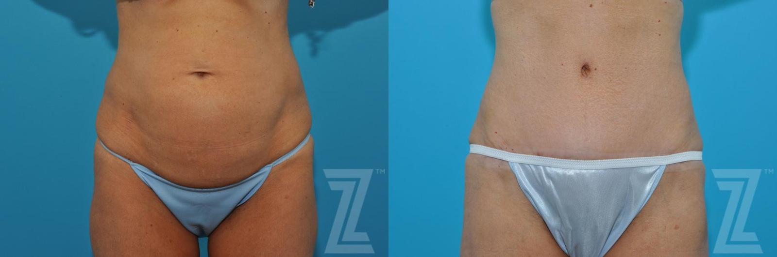Austin Tummy Tuck Before & After Gallery - Patient 132886871 - Image 1 - The Piazza Center