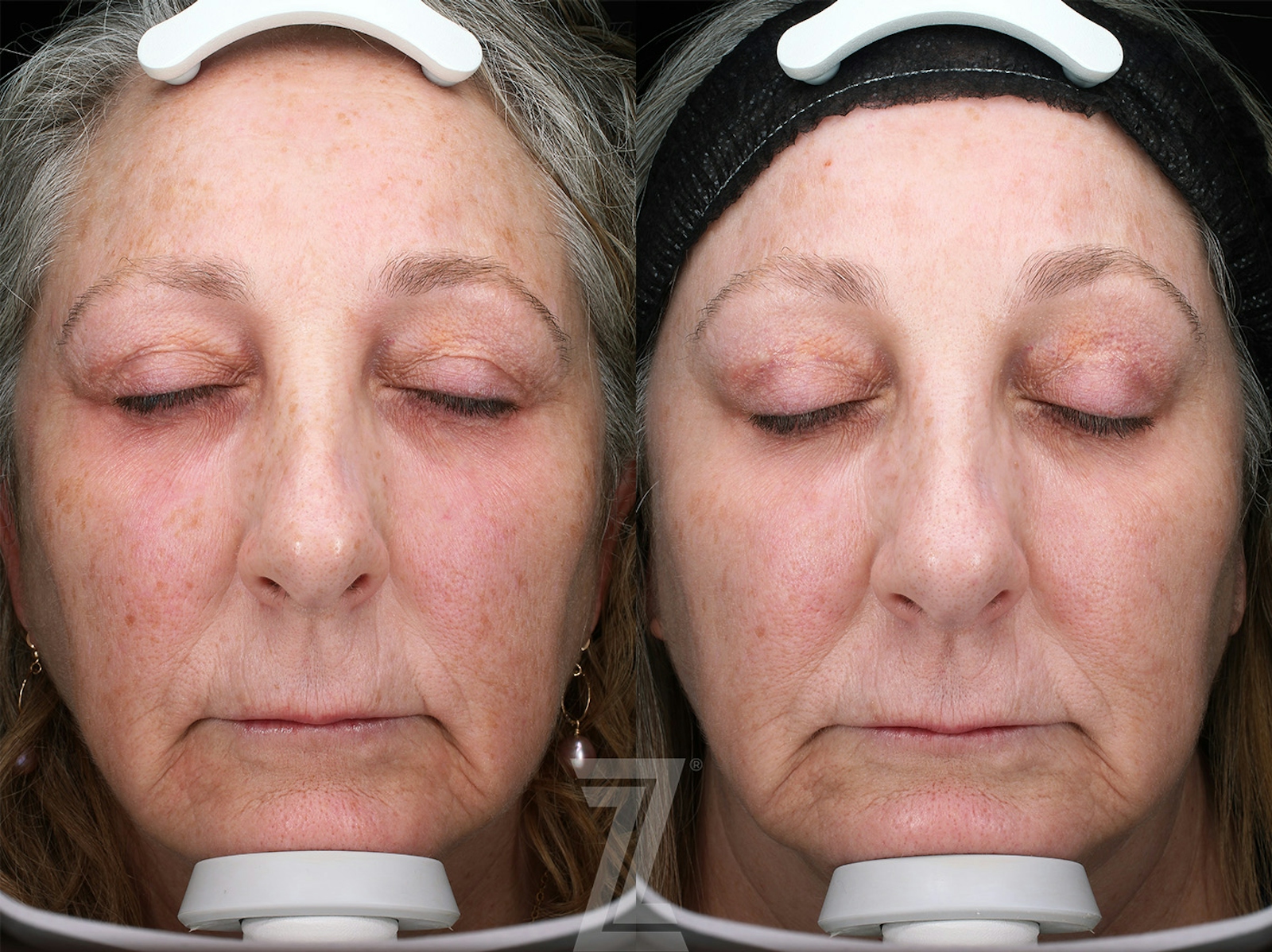 Austin HALO Before & After Gallery - Patient 192175 - Image 1 - The Piazza Center
