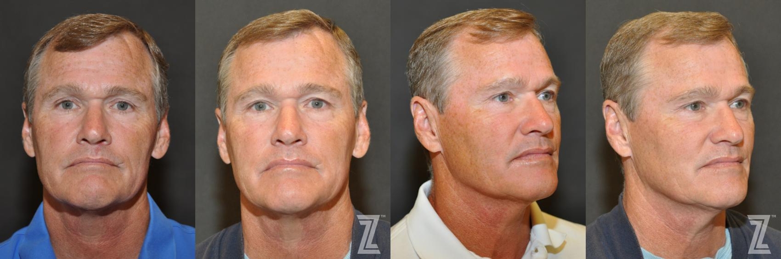 Austin Chemical Peel Before & After Gallery - Patient 132963248 - Image 1 - The Piazza Center