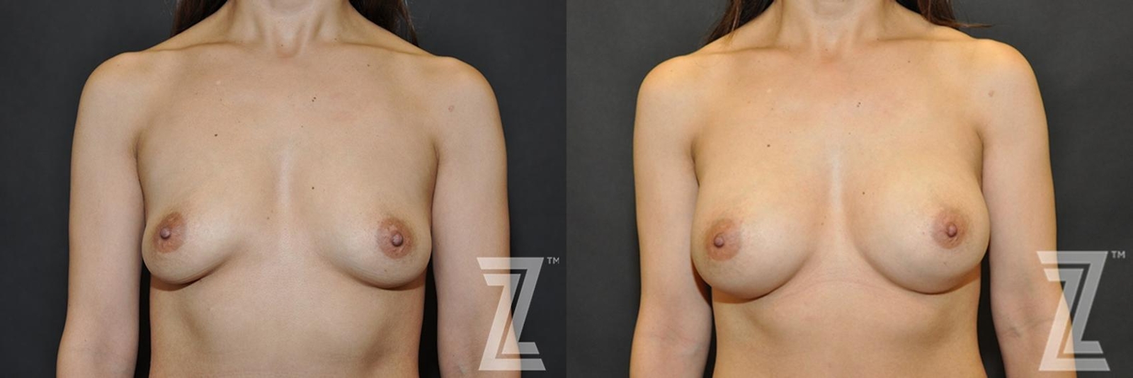 Austin Frontal view of before & after image of 40 year old woman with Silicone Implants with Cohesive Silicone Gel - The Piazza Center