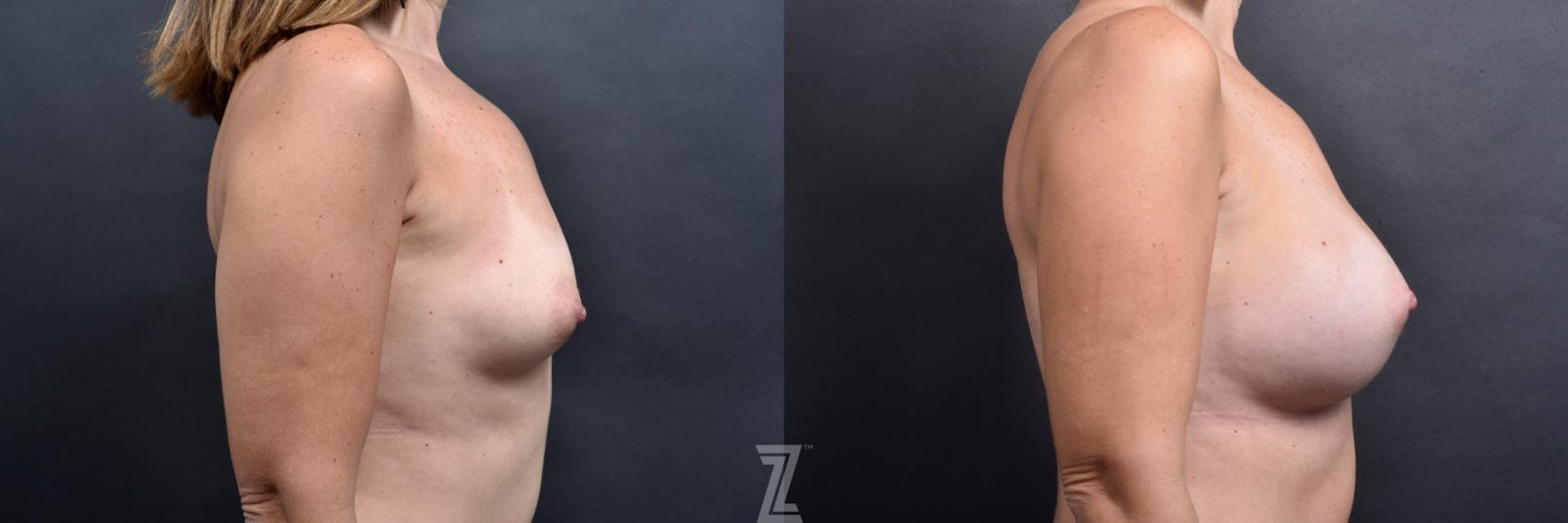Austin lateral before and after images of 39 year old woman with Silicone Implants with Cohesive Silicone Gel - The Piazza Center - The Piazza Center