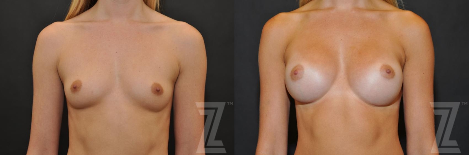 Austin 27 year old woman before and after breast augmentation front view - The Piazza Center