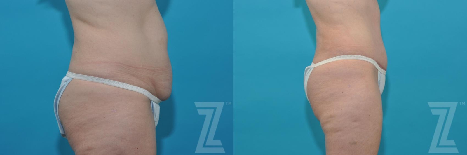 Austin Tummy Tuck Before & After Gallery - Patient 132886814 - Image 4 - The Piazza Center