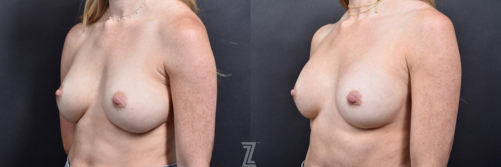 Austin Breast Augmentation Revision Before & After Gallery - Patient 132886589 - Image 2 - The Piazza Center