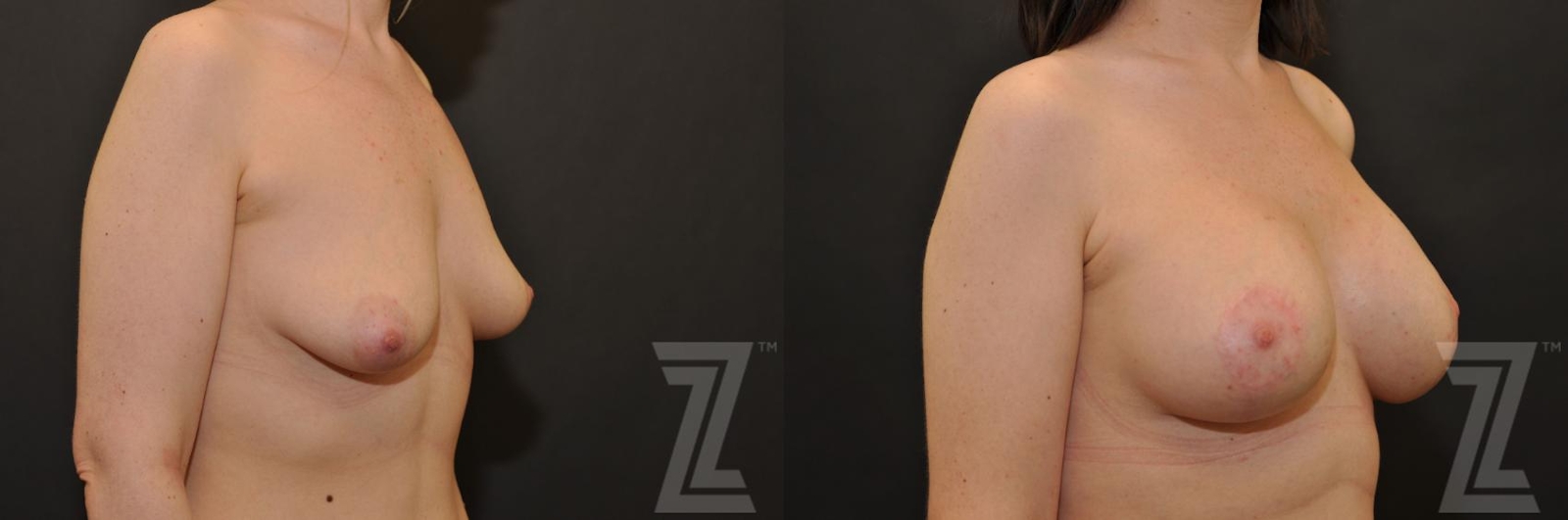 Austin Correction of Breast Asymmetry Before & After Gallery - Patient 132886780 - Image 4 - The Piazza Center