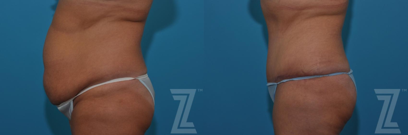 Austin Tummy Tuck Before & After Gallery - Patient 132886809 - Image 2 - The Piazza Center