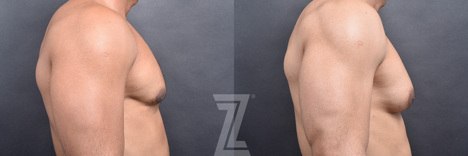 Austin Gynecomastia/Male Breast Reduction Before & After Gallery - Patient 377773 - Image 3 - The Piazza Center