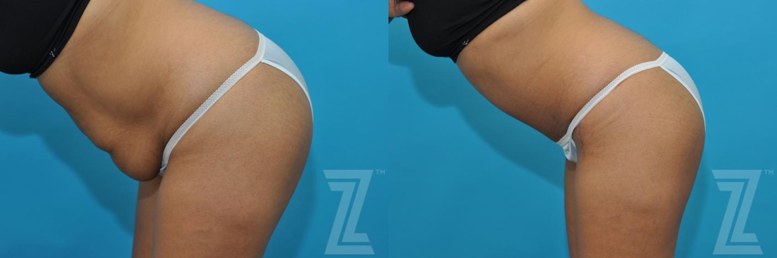 Austin Tummy Tuck Before & After Gallery - Patient 132886811 - Image 3 - The Piazza Center