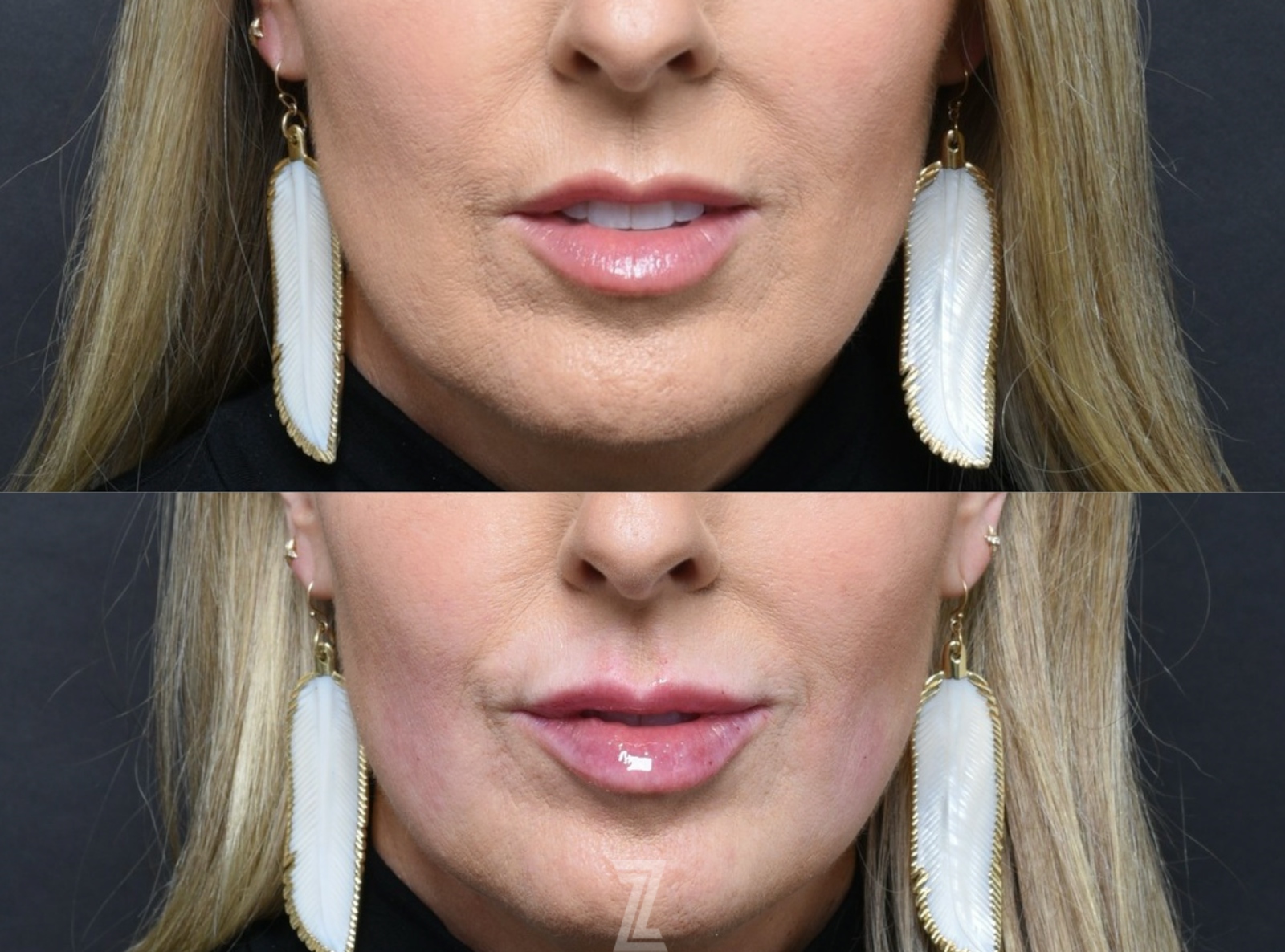 Austin Injectable Lip Fillers Comparison - The Piazza Center