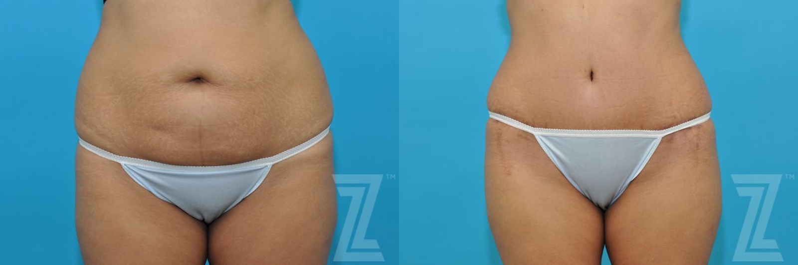 Austin Tummy Tuck Before & After Gallery - Patient 132886811 - Image 1 - The Piazza Center