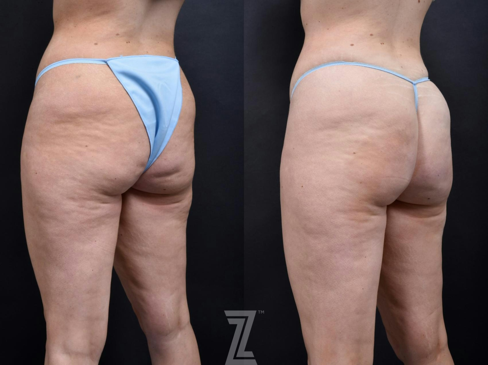 Austin Avéli Before & After Gallery - Patient 132905400 - Image 2 - The Piazza Center