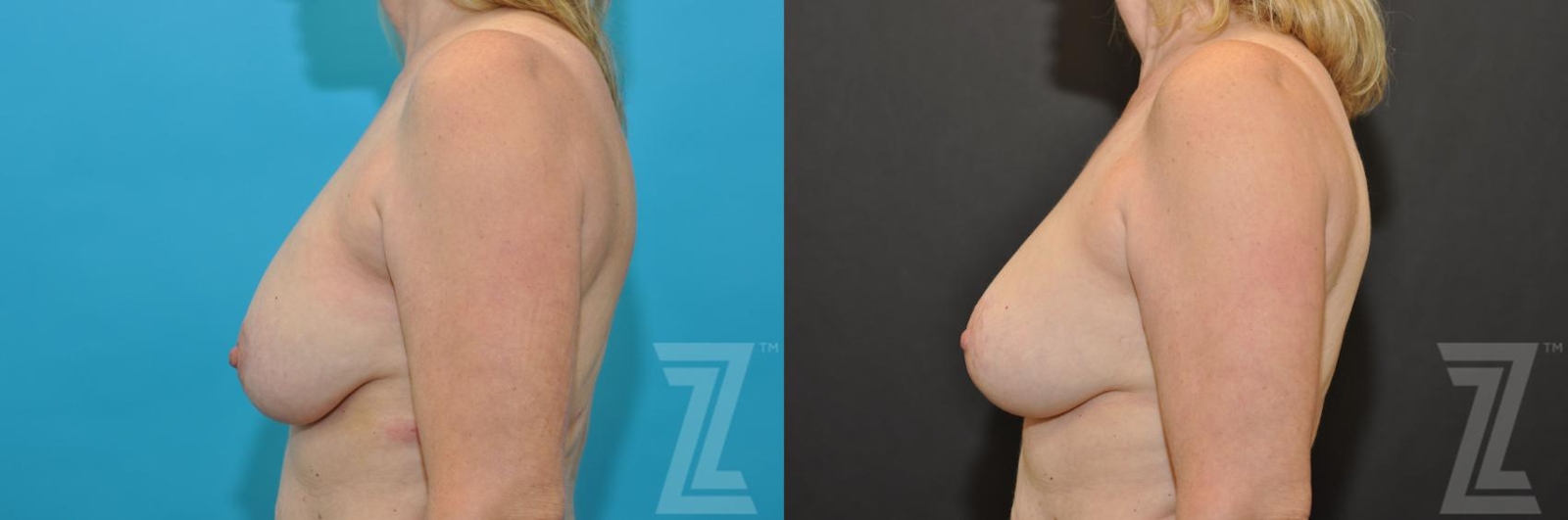 Austin Breast Augmentation Revision Before & After Gallery - Patient 132793346 - Image 3 - The Piazza Center