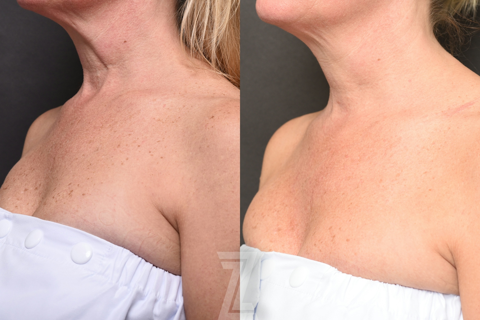Austin BBL Before & After Gallery - Patient 138650 - Image 2 - The Piazza Center
