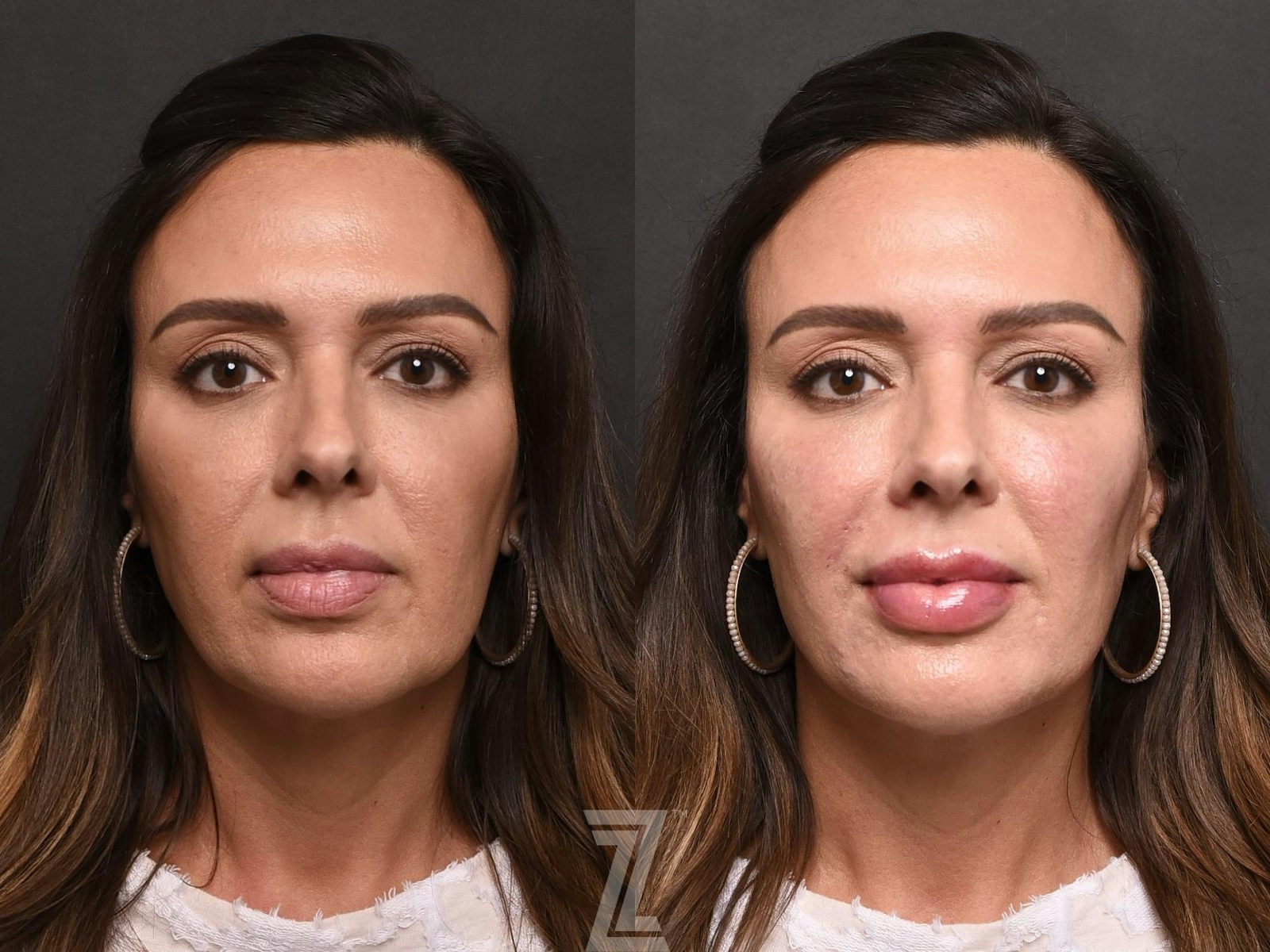 Austin Injectable Fillers Before & After Gallery - Patient 132963109 - Image 1 - The Piazza Center
