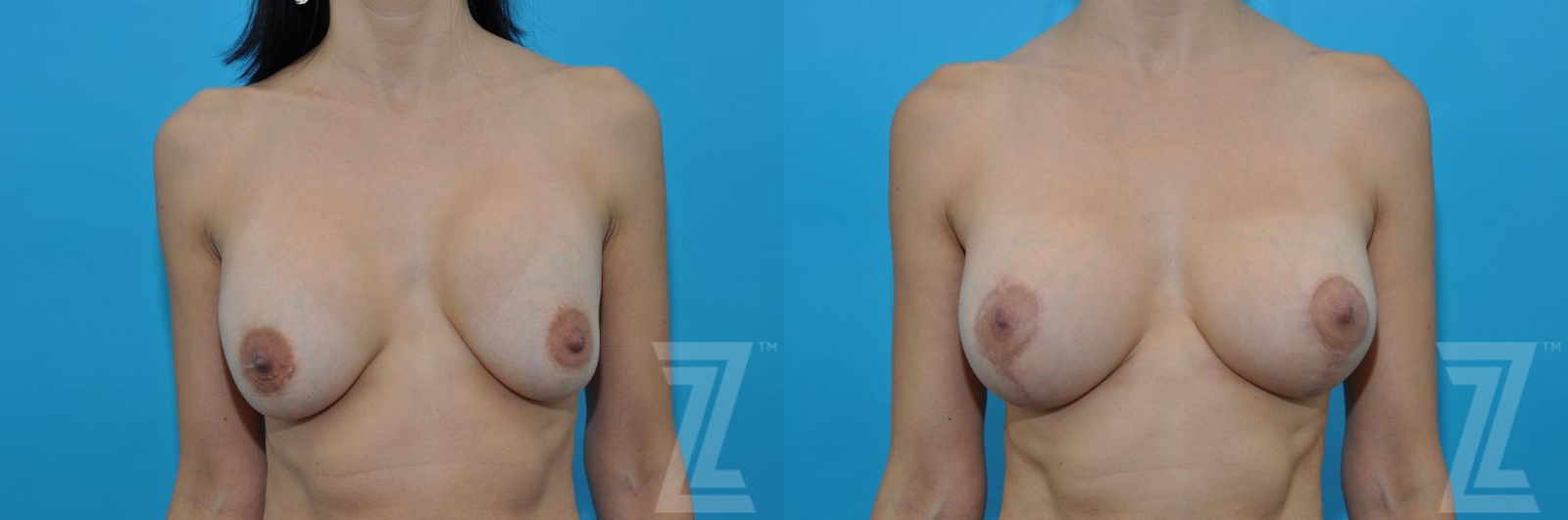 Austin Breast Augmentation Revision Before & After Gallery - Patient 132886578 - Image 1 - The Piazza Center