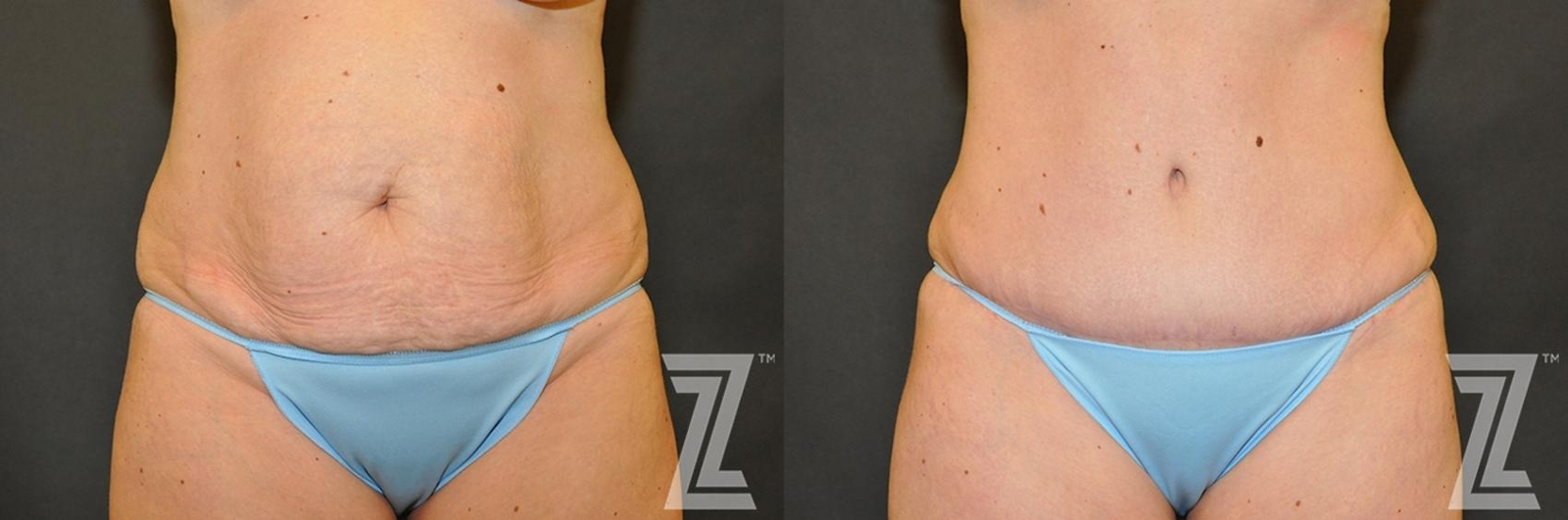 Austin Tummy Tuck Before & After Gallery - Patient 132886883 - Image 1 - The Piazza Center