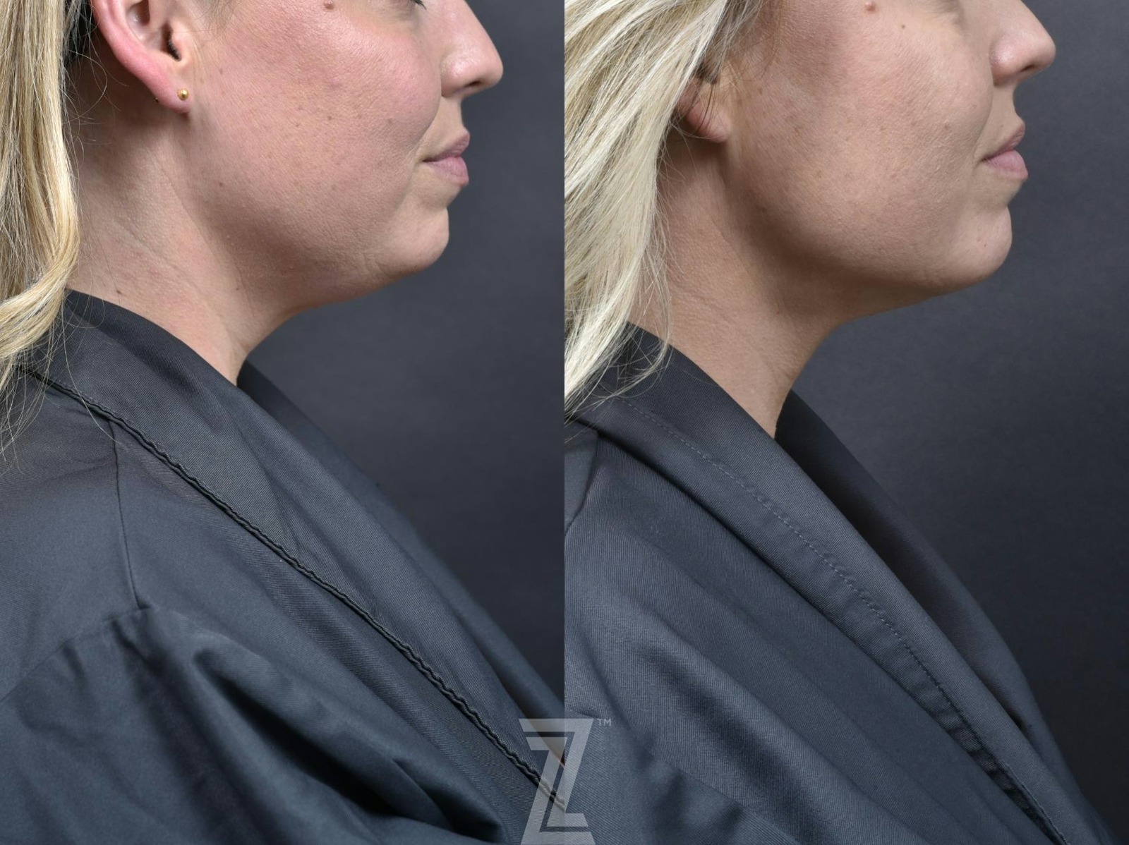 Austin KYBELLA® Before & After Gallery - Patient 132963130 - Image 1 - The Piazza Center