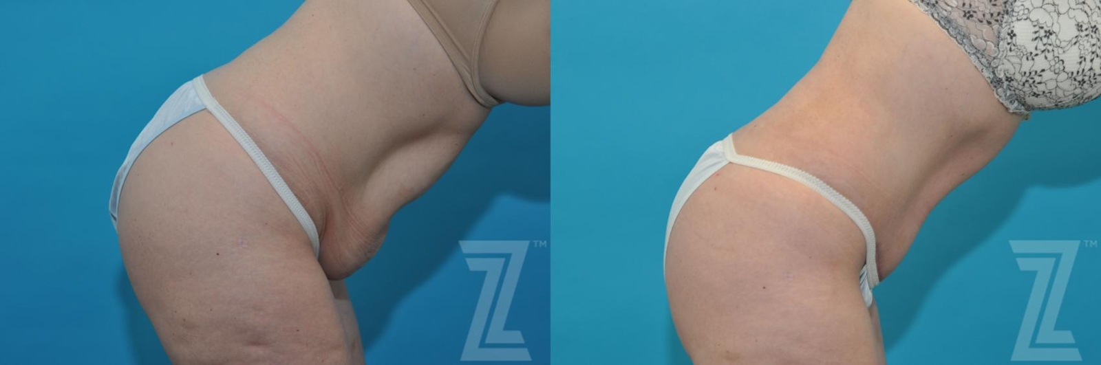 Austin Tummy Tuck Before & After Gallery - Patient 132886874 - Image 6 - The Piazza Center